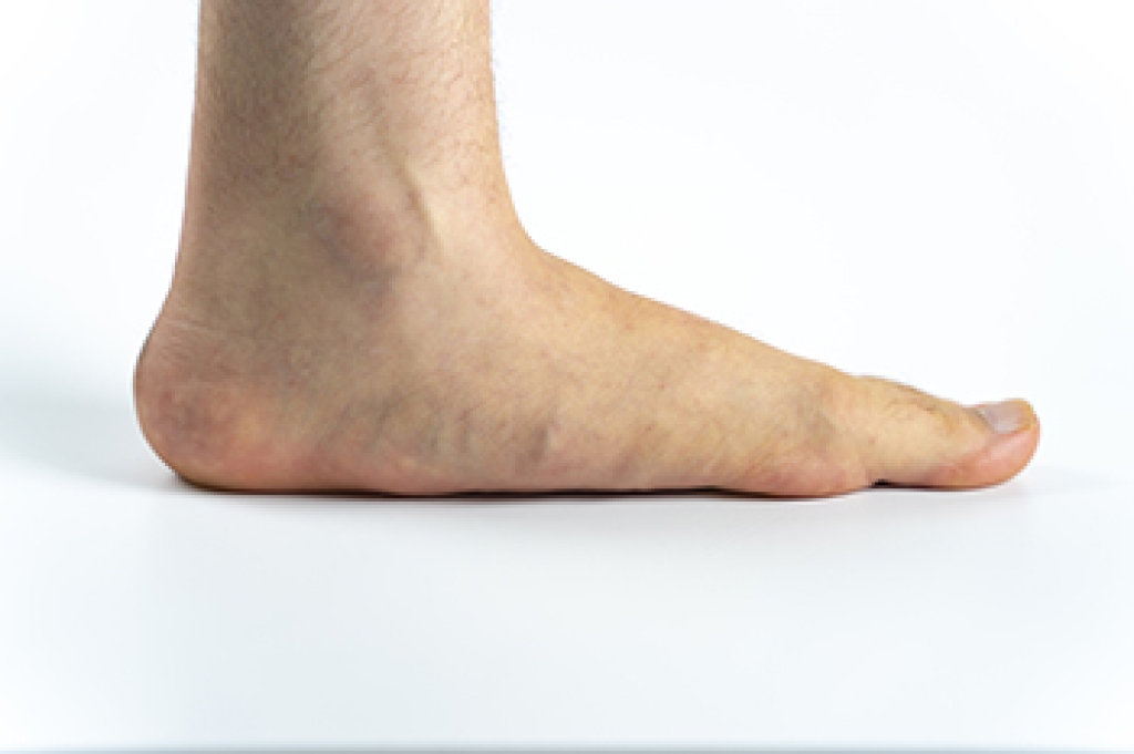 Flat Feet Causes