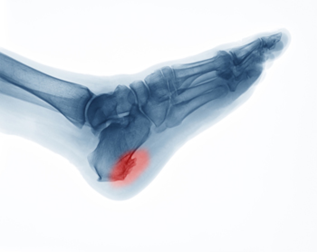 Symptoms of Heel Spurs