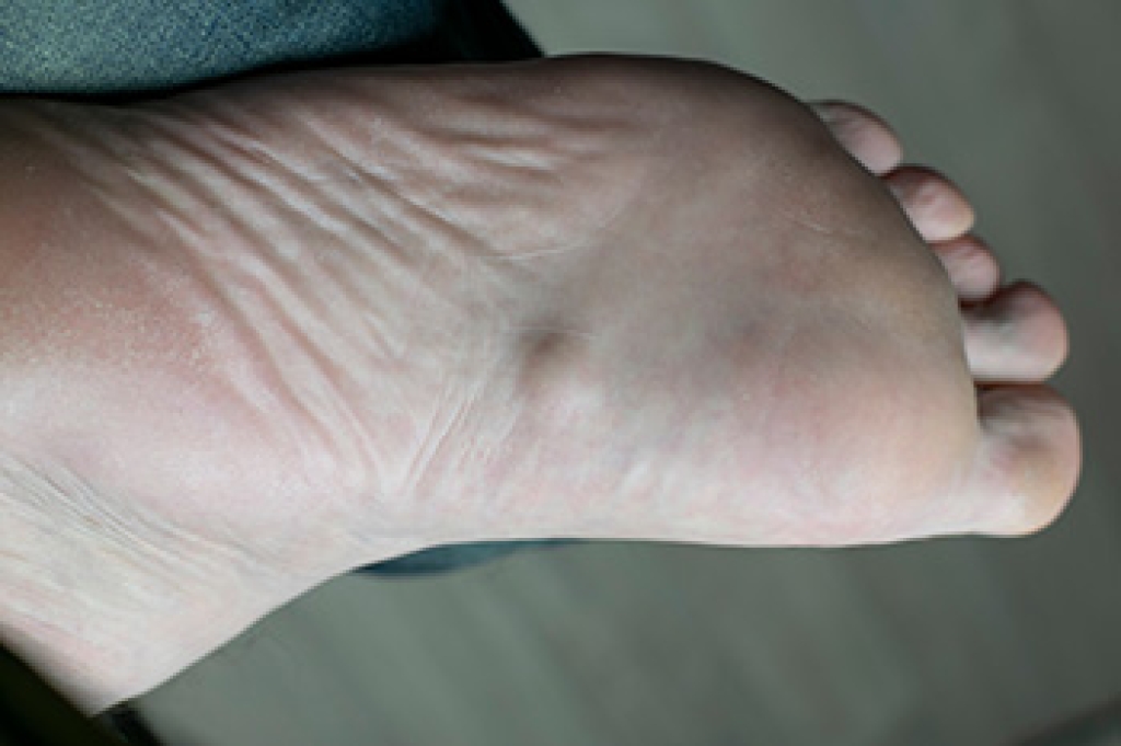 Causes and Treatment of Bumps on the Sole of the Foot