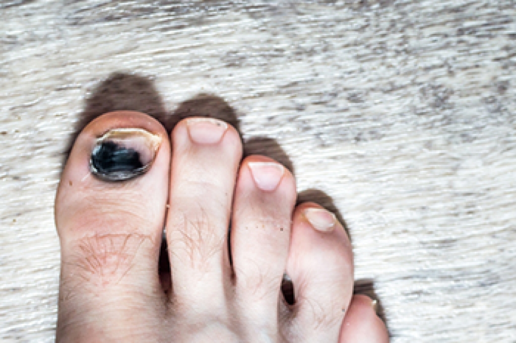 What Causes Toenails to Turn Black?