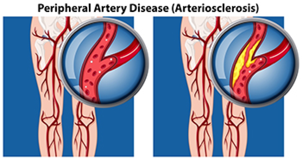 Signs of Peripheral Artery Disease in the Feet