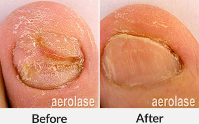 aerolase nails treatment