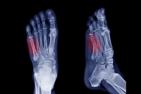 Symptoms and Treatment of a Jones Fracture