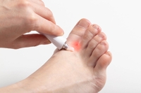 Treating Athlete’s Foot