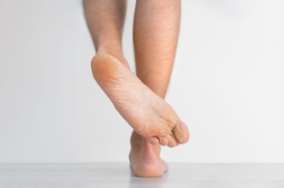 Managing Athlete’s Foot