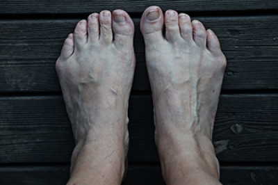 Understanding the Painful Bump of a Bunionette