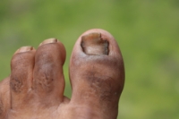 Managing Fungal Toenail Infections