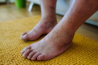 Taking Care of Your Diabetic Feet